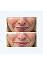 view 7 of 10 Precision Peel in 