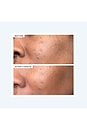 view 8 of 10 Precision Peel in 