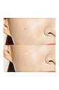 view 9 of 9 TRAITEMENT ANTI-ACNÉ ACNE PIMPLE MASTER in 