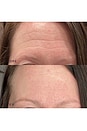 view 3 of 6 Forehead Occlusion Patch in 