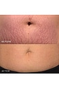 view 4 of 7 Belly & Body Occlusion Patch in 