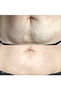 view 6 of 7 Belly & Body Occlusion Patch in 
