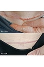 view 2 of 5 Scar Occlusion Patch in 