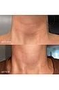 view 2 of 5 Neck Occlusion Patch in 