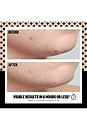 view 4 of 10 PATCHES PARA ESPINHAS SALICYLIC ACID ACNE HEALING DOTS 20 DOTS in 