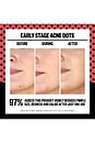 view 2 of 6 2% Salicylic Acid Early Stage Acne Dot 8 Dots in 