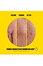 view 2 of 10 Salicylic Acid Acne Day Dots 20 Dots in 