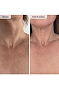 view 4 of 8 Neck & Decolletage LED System in 