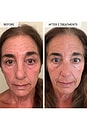 view 9 of 12 TRATAMENTO ANTIENVELHECIMENTO MICRO-INFUSION in 