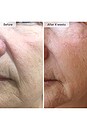 view 7 of 8 TRATAMENTO ANTIENVELHECIMENTO MICRO-INFUSION in 