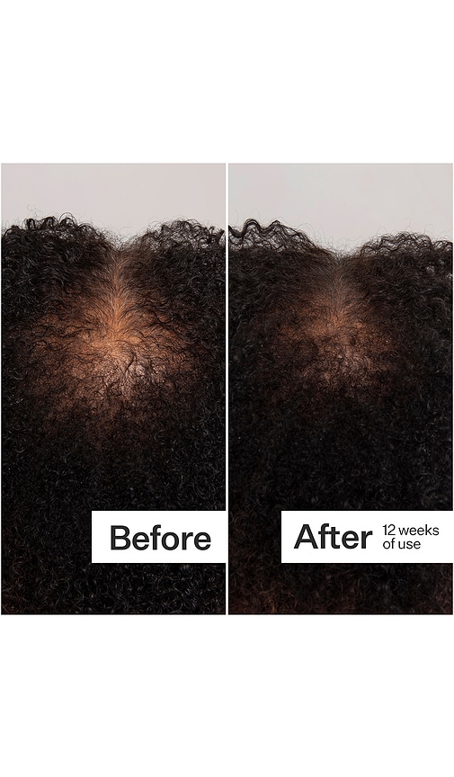  Act+acre Sello Dermatológico Scalp Dermastamp For Thicker + Fuller Looking Hair En Color Belleza: Na Talla All . 