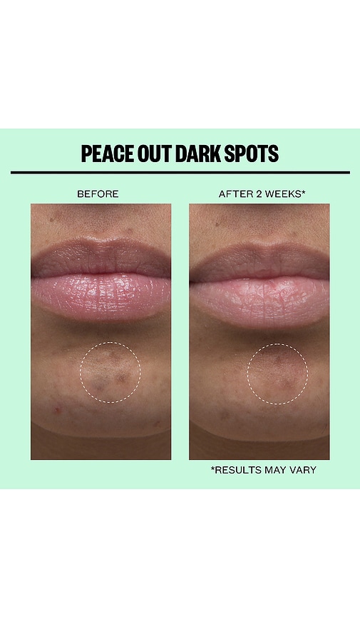 Peace Out Microneedling Dark Spot Brightening 12 Dots