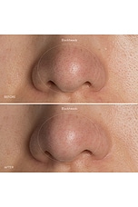 KIWI Blackhead Remover Device - thumbnail 7