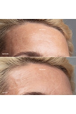 KIWI Derma Microdermabrasion Device - thumbnail 8