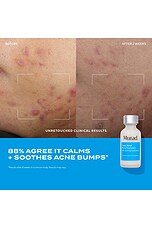 Deep Relief Acne Treatment - thumbnail 6