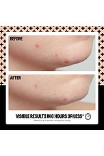 Salicylic Acid Acne Healing Dots 20 Dots - thumbnail 7