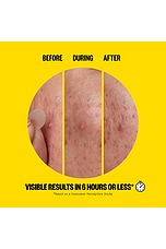 Salicylic Acid Acne Day Dots 20 Dots - thumbnail 5