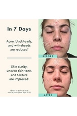 Miracle Clear Acne Serum - thumbnail 8