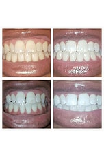 Extra-Strength Teeth Whitening Gold Wand Serum - thumbnail 6