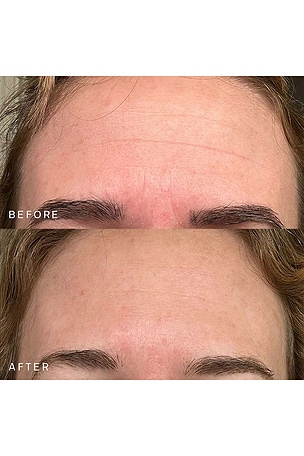 Dermaclara Forehead Occlusion Patch in Beauty: NA