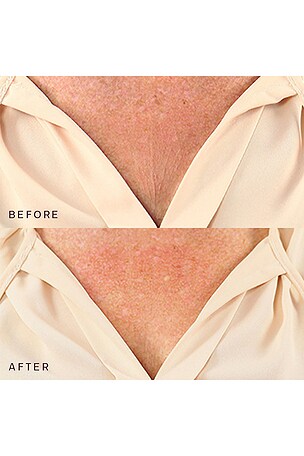 Dermaclara Decollette, Breast & Butt Occlusion Patch en Beauty: S