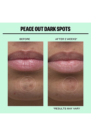 Peace Out Microneedling Dark Spot Brightening 12 Dots.