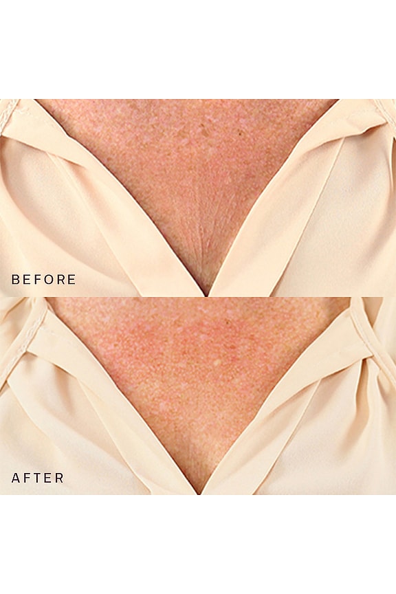 view 2 of 6 Decollette, Breast & Butt Occlusion Patch in 