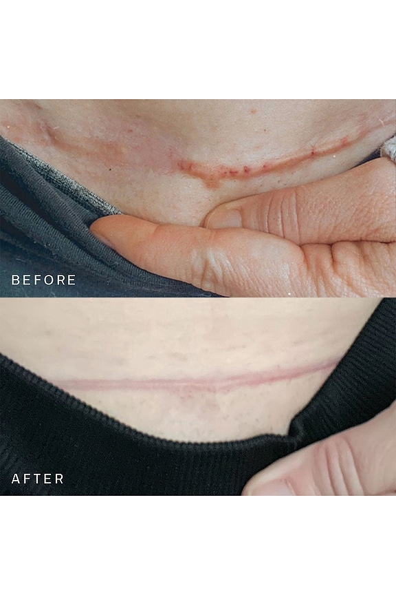 view 2 of 5 PARCHE PARA MARCAS. SCAR OCCLUSION PATCH in 