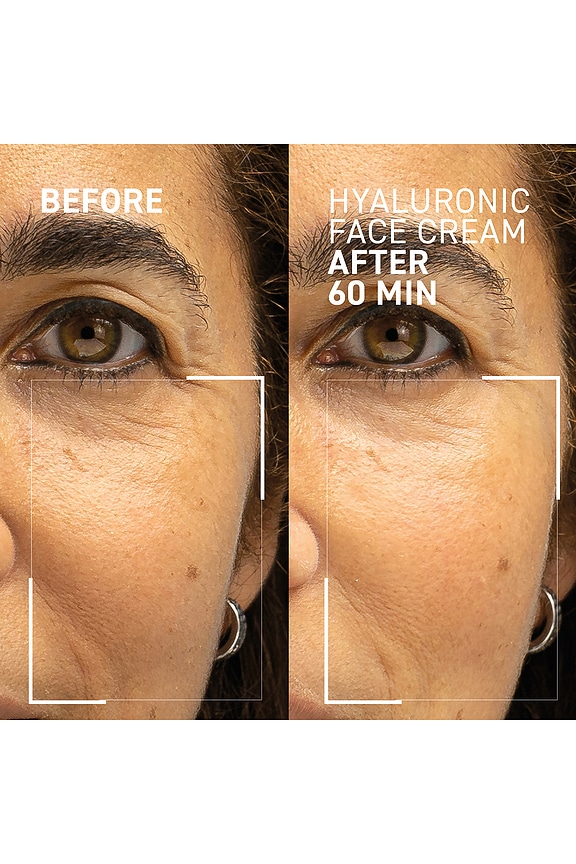 view 2 of 7 Needles No More Hyaluronic Face Cream in 