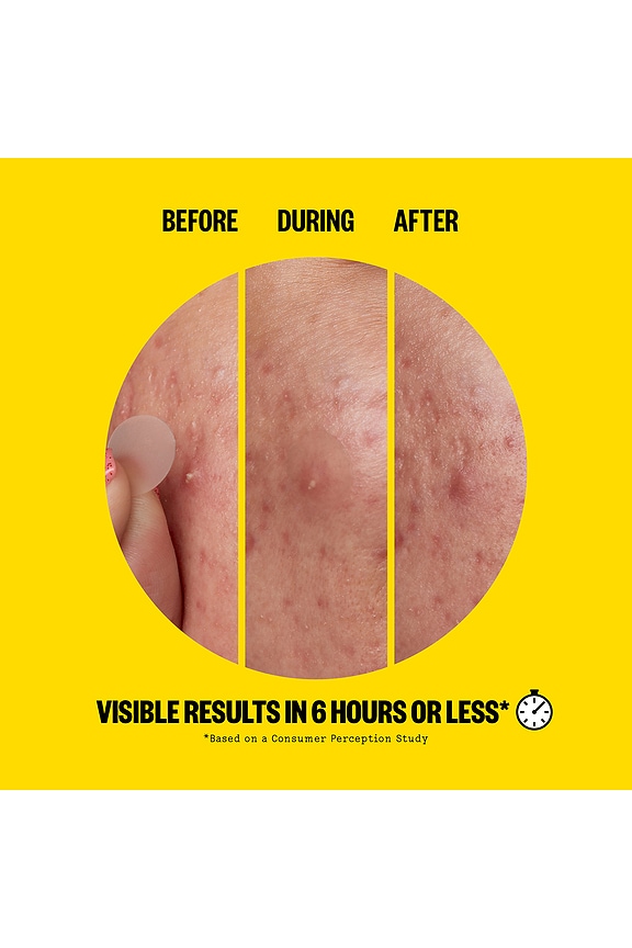 view 2 of 10 Salicylic Acid Acne Day Dots 20 Dots in 