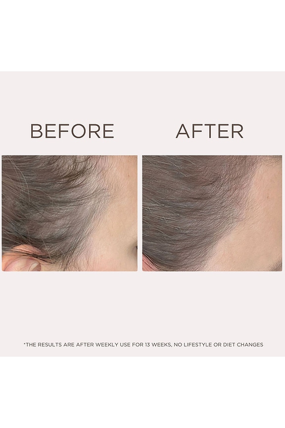 view 2 of 7 Need More Anti-Hair Loss Serum Treatment in 