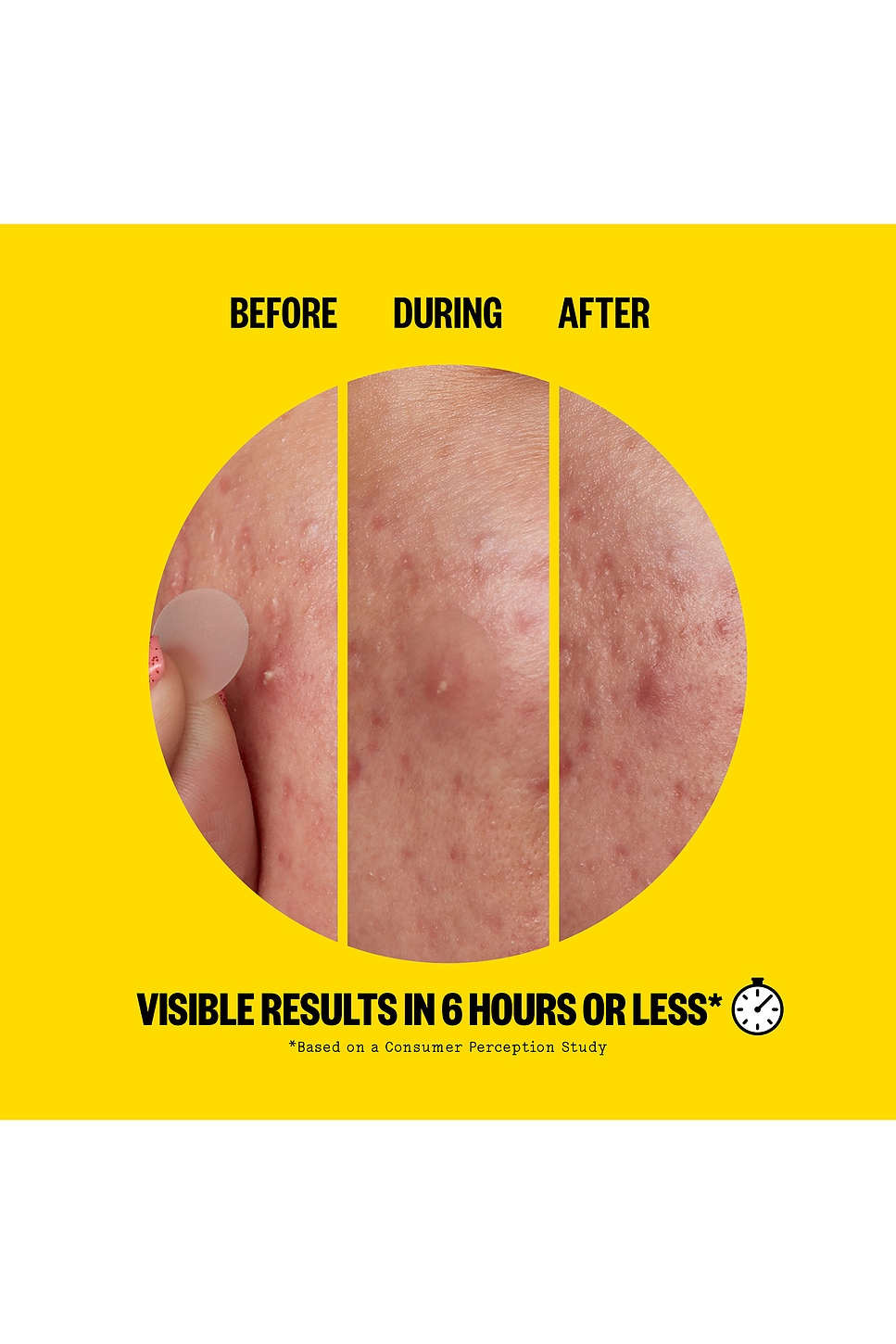 Salicylic Acid Acne Day Dots 20 Dots - thumbnail 3